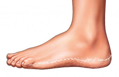 El hongo de las uñas en los pies chelyabinsk